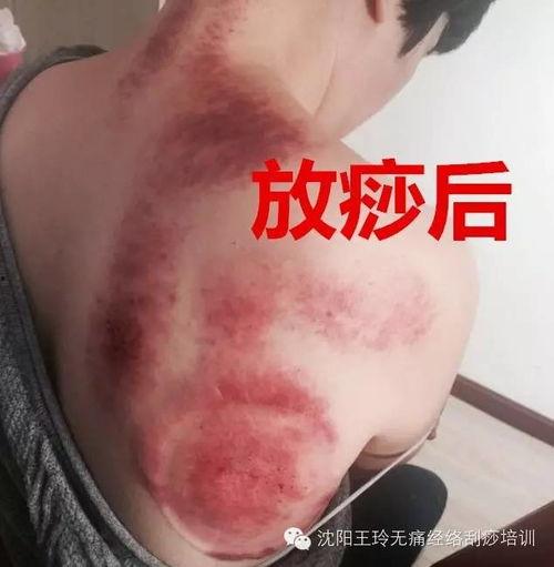 刮痧教学视频,轻松掌握传统养生技巧