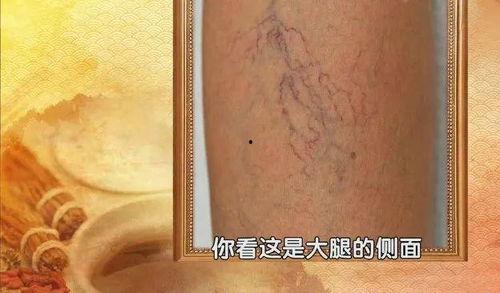 静脉曲张刮痧视频,轻松缓解不适，焕活健康生活
