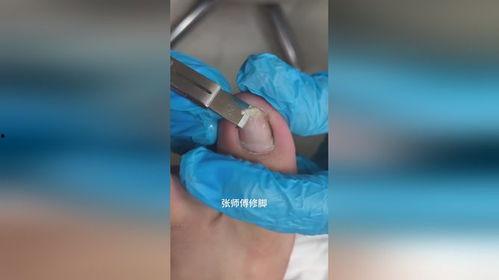 修脚视频甲沟炎,甲沟炎的成因与防治方法