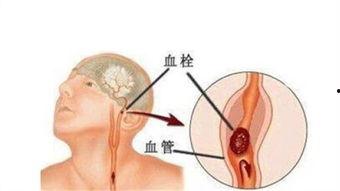 血管堵塞视频,揭秘健康隐患与防治之道