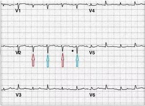 心电图视频,捕捉心脏跳动背后的秘密